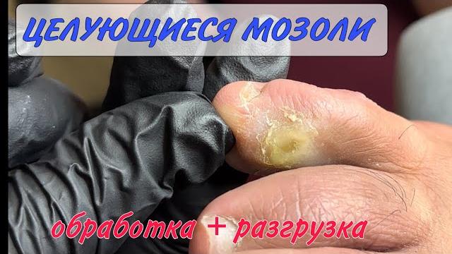 ❗️мозоли между пальцев/ разгрузка мозолей/👌🏻целующиеся мозоли