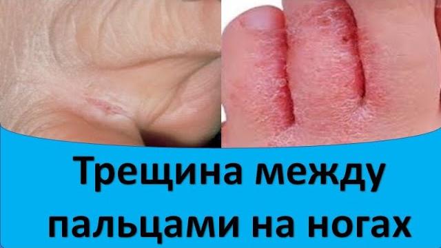 Трещина между пальцами на ногах