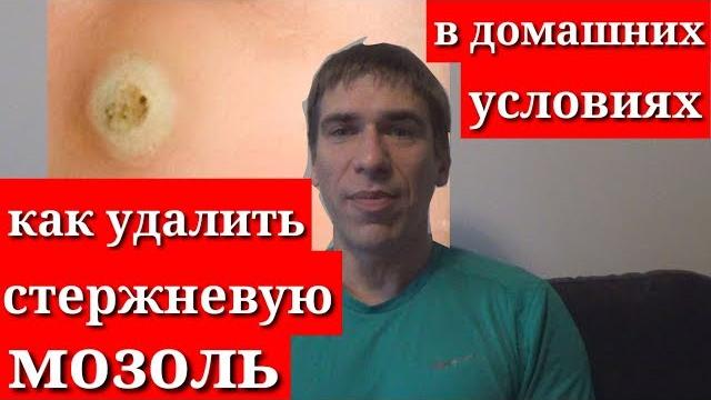 Стержневая мозоль как удалить в домашних условиях